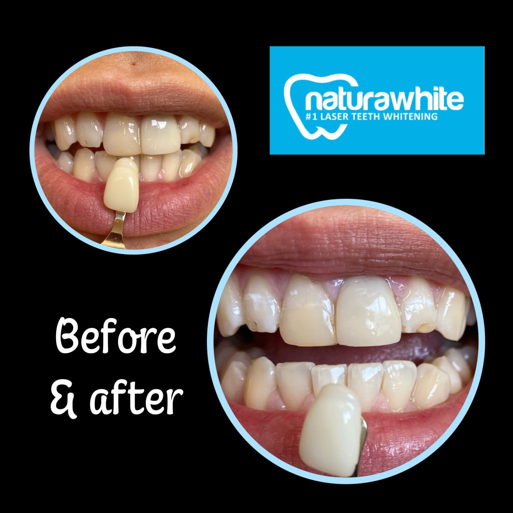 Naturawhite teeth whitening