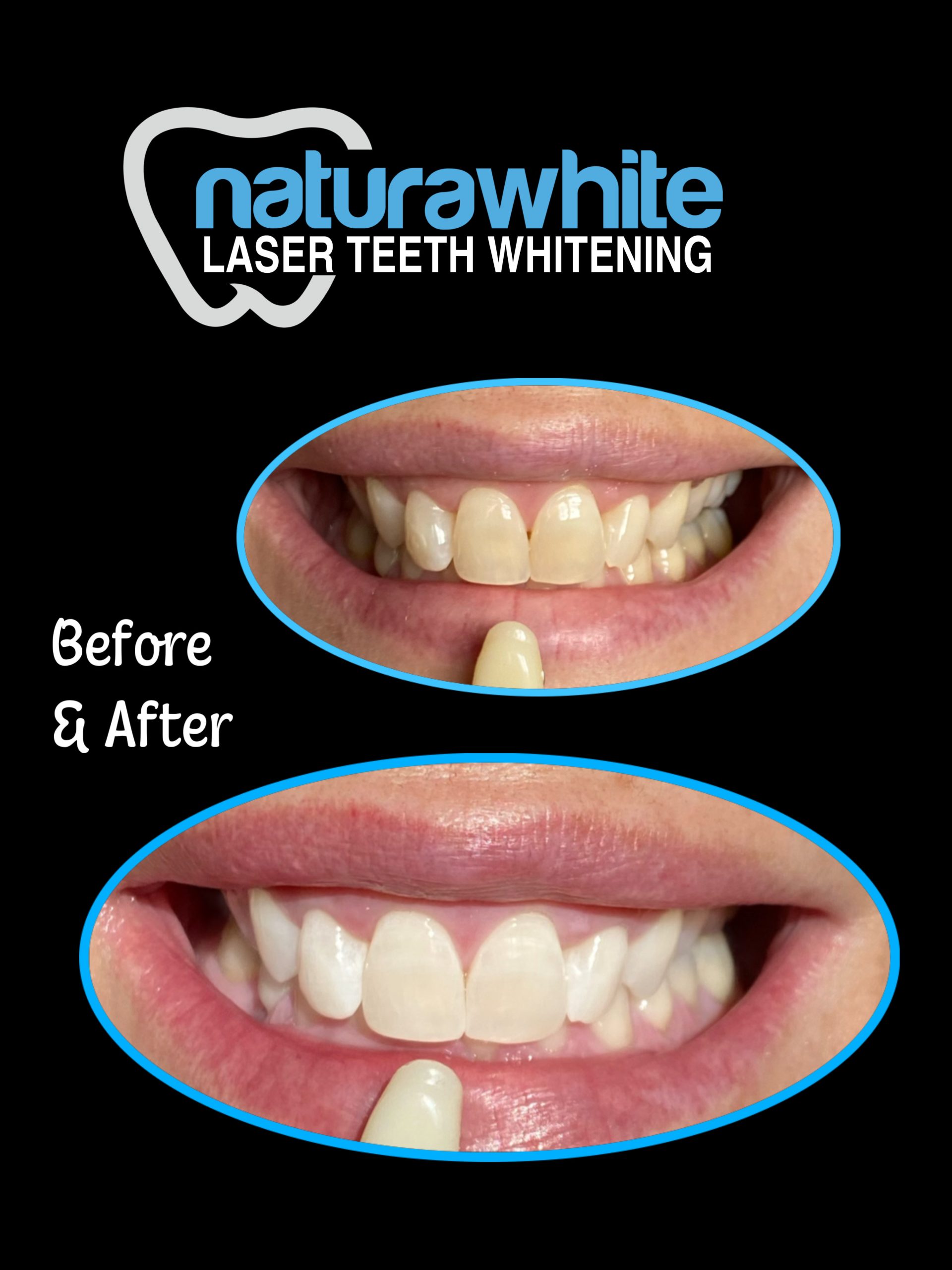 Laser Teeth Whitening Nottingham