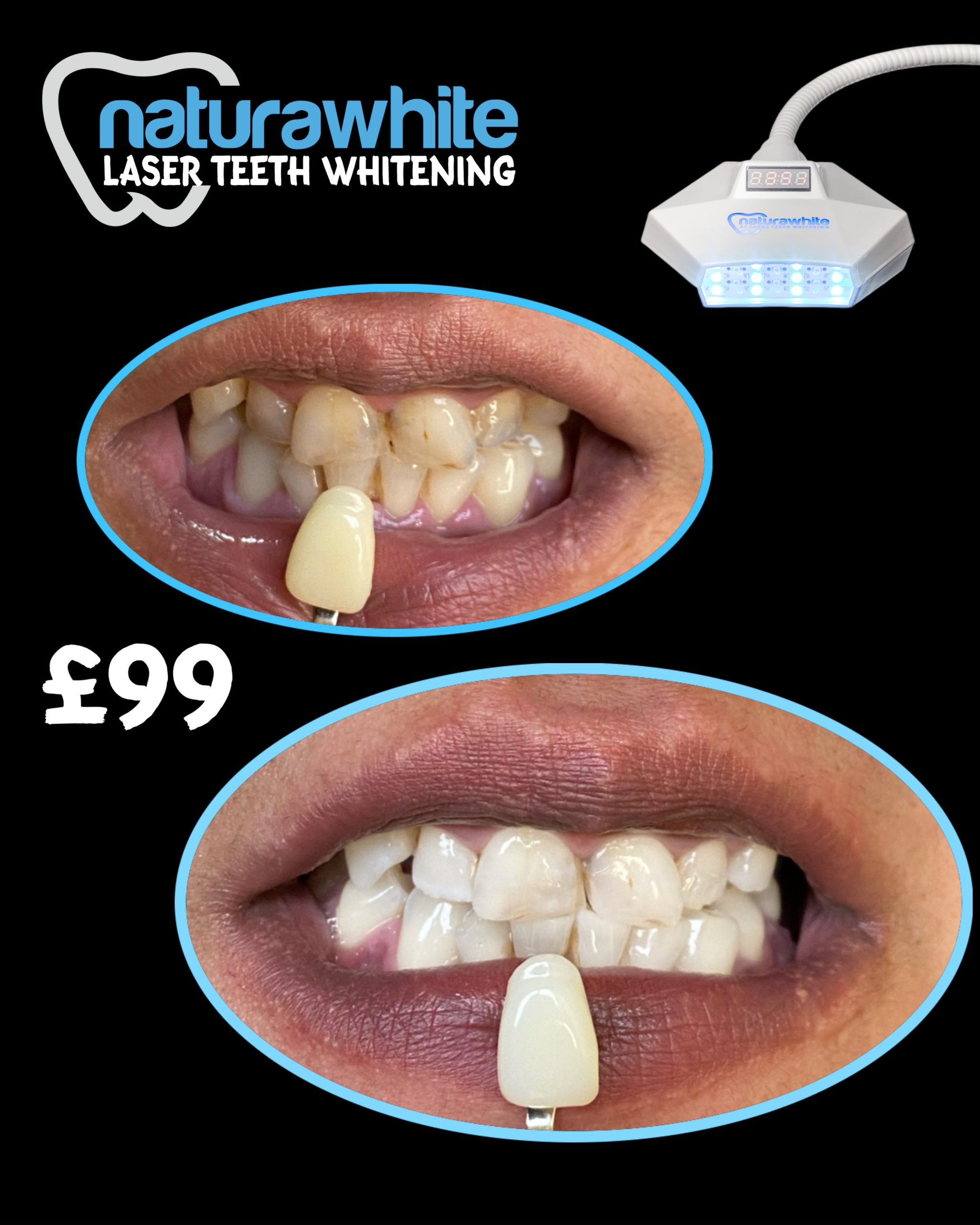 Laser Teeth Whitening, Nottingham Naturawhite