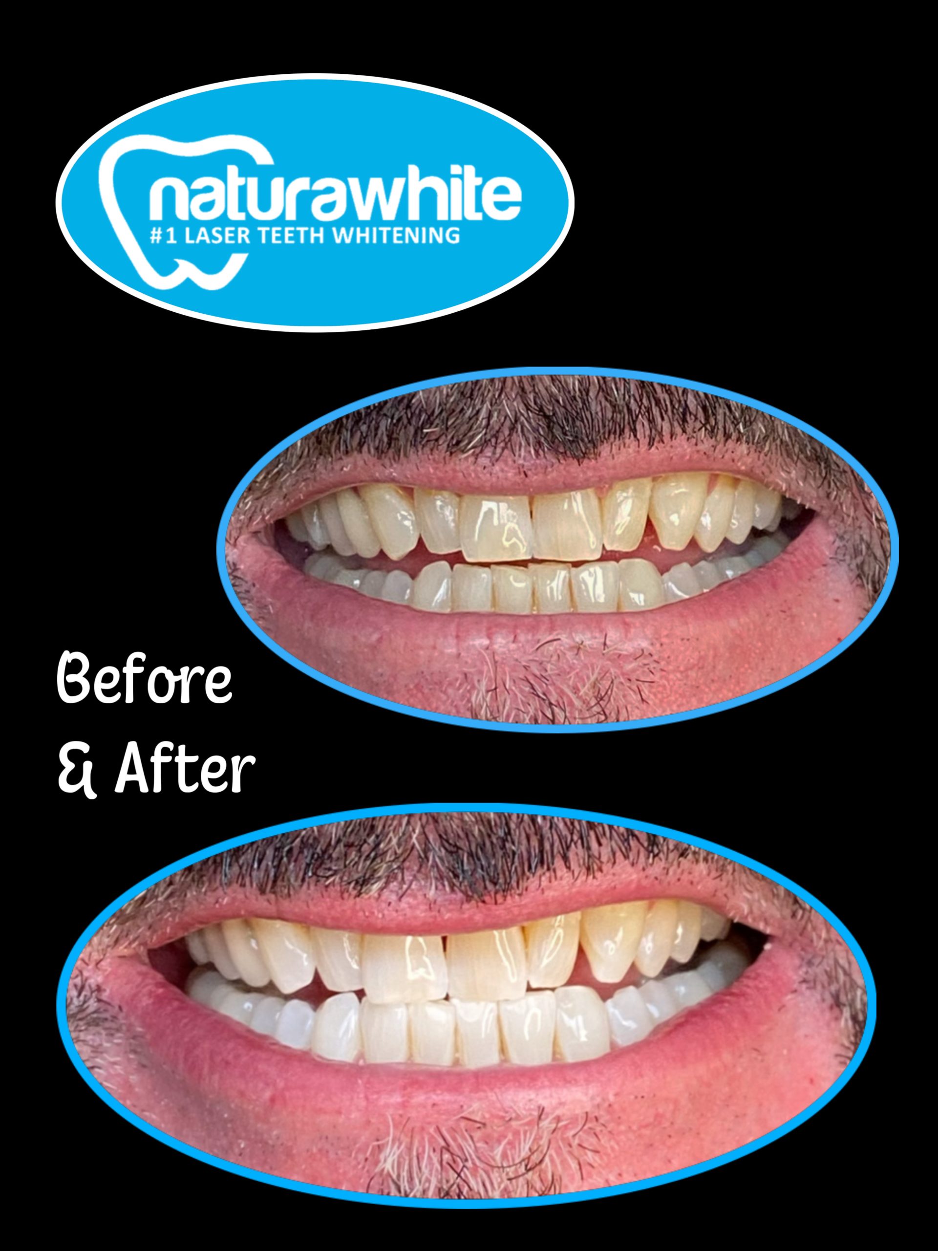 Laser Teeth Whitening Nottingham