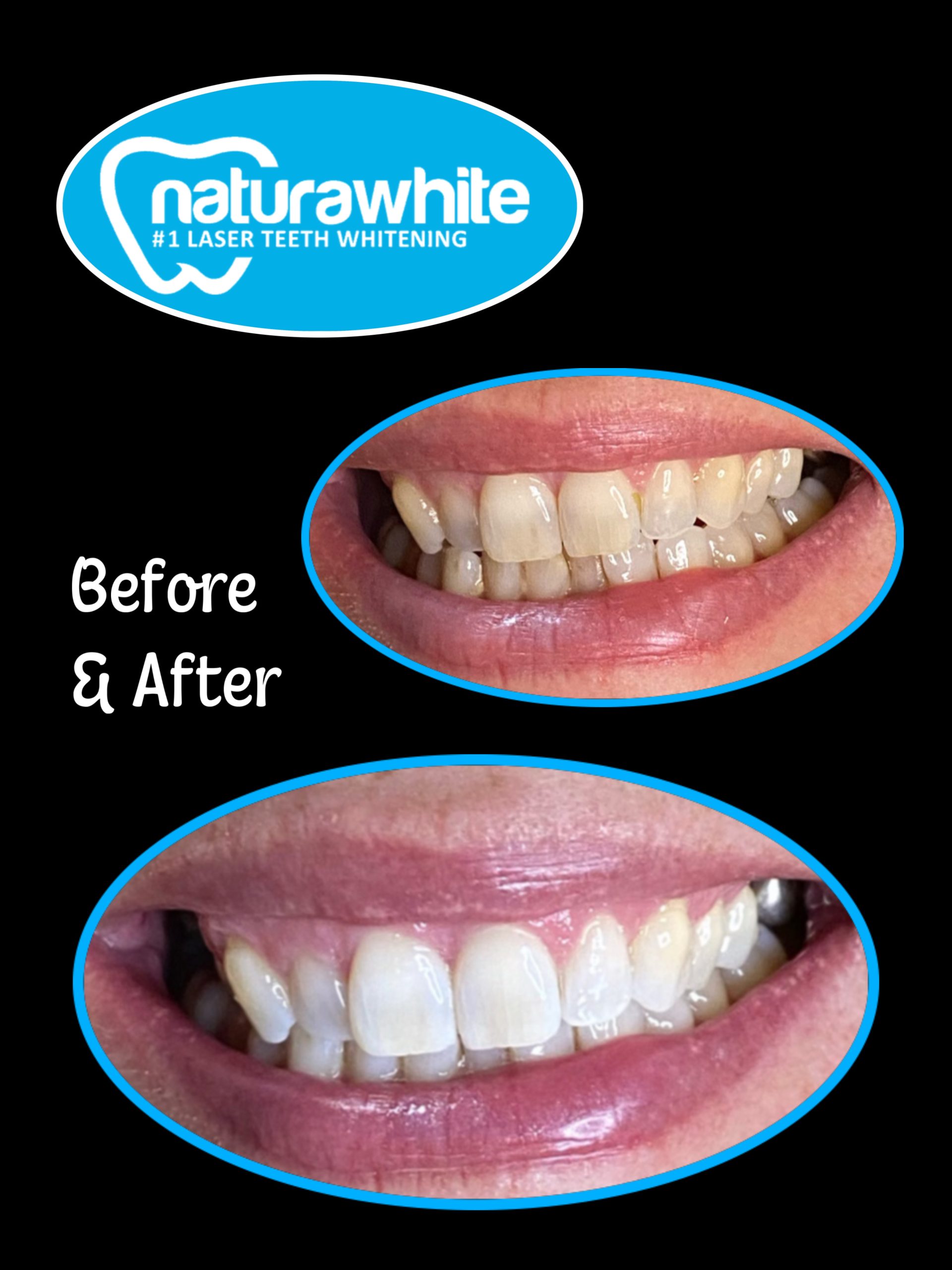 Laser Teeth Whitening Nottingham